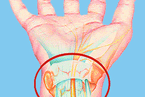  Anatomisches Modell des Karpal-Tunnel-Syndroms 